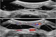 Diagnostic Accuracy of Ultrasound in Determining the Cause of Bilious Vomiting in Neonates